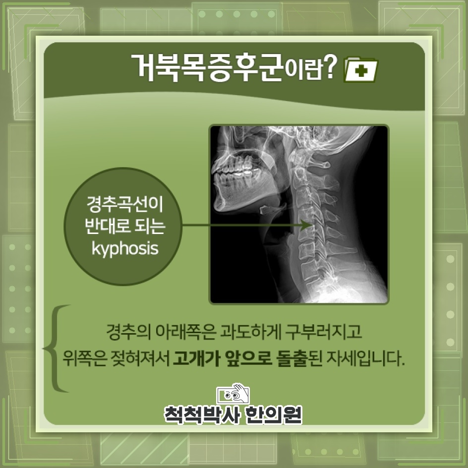고개를 숙이는 습관이 거북목증후군으로 이어지는 과정